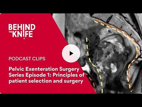 Pelvic Exenteration Surgery Series Episode 1: Principles of patient selection and surgery
