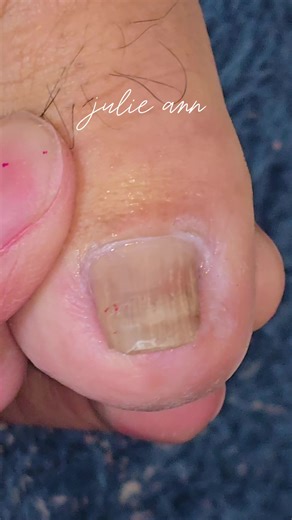 ang laki ng nakabaong ingrown #manikuristangligaw | Ingrown hair