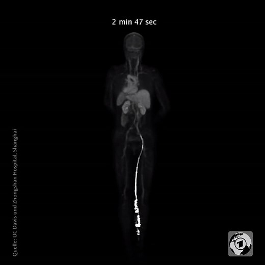 Ein neuer 3D-Scanner zeigt Medizinern, wie sich ein Medikament im Körper ausbreitet. | tagesschau