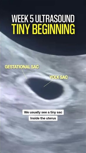 Subchorionic Hematoma matters #shorts #drshivradiologist