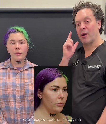 MINI DEEP PLANE FACELIFT BEFORE AND AFTER PHILIP SOLOMON