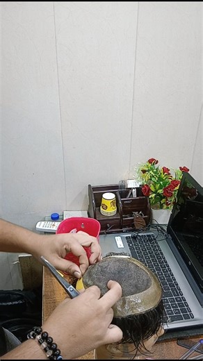 hair patch on Instagram: ""Life-Changing Hair Patch Result – Before vs After!" #hairwig #hairpatch #trendingreels #bigbesthairfixing #hairreplacement #viralreels"