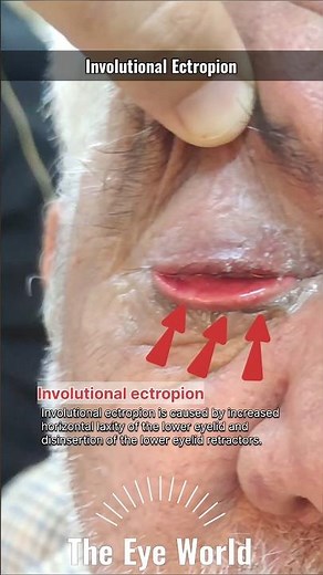 involutional ectropion #eyes #ophthalmology #the_eye_world #youtubeshorts #eyelids