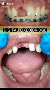 Digital PMMA Fixed Bridge - All You Need to Know