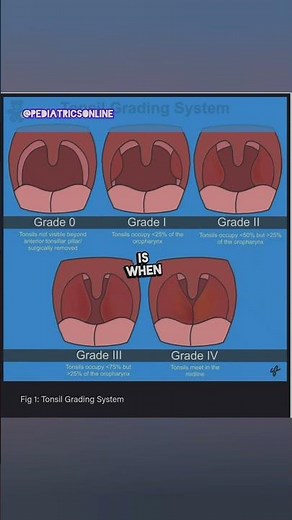 Grades of tonsil enlargement #brodsky #tonsil #grades #paediatrics #ent #dnb #neet #fmge #mcq #osce