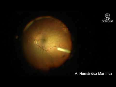 Vista intraocular inyección Ozurdex®
