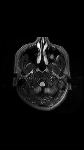 MENINGIOMA #radiologycouse #mri #mri #anatomy #meningioma #radiology