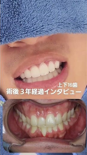 ３年経過のインタビューです#セラミック#セラミック矯正#ダイヤモンド今井院長