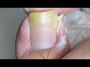 Extremely long nail cutting
