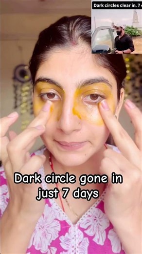 Dark Circles Gone in 7 Days 😱 | No Cream No Treatment | Natural Home Remedy
