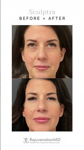 What Sets Sculptra Apart From Traditional Fillers