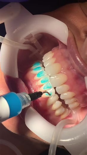 Just a little #braces #asmr