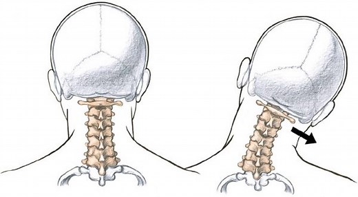 Head Tilt Posture: What It Is and How to Fix It