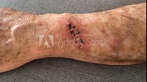 Mature man arm with sutures after Mohs surgery for skin cancer removal