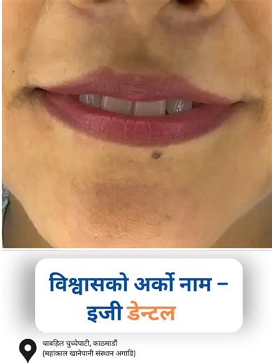 😷 मुख लुकाउनु होइन, 😁 हाँसो देखाउनुहोस्! अब दाँतको समस्या लुकाउने होइन, समाधान खोज्ने समय हो। इजी डेन्टलसँग पाउनुहोस् सजिलो, सुरक्षित र विश्वासिलो उपचार। 📍महांकाल, काठमाडौं 📞 9841214877 / 01-4563633 Easy Dental is a well-established dental clinic in Chabahil, Kathmandu, with 30 years of experience in providing high-quality dental care. If you're looking for the best dentist for root canal treatment, Easy Dental is a great choice due to the following reasons: ✅ Experienced Dentists – Skilled 