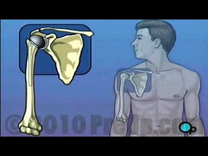 Shoulder Replacement PreOp® Patient Education