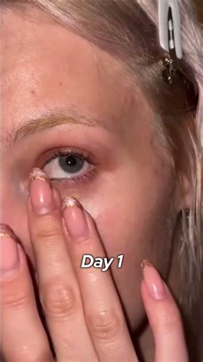 How to get rid of dark eye bags