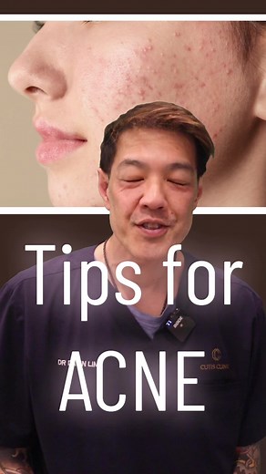 My tips for dealing with acne! A special partnership with the amazing @synergieskin #sponsored #cleanscience #synergieskin #dermatologist #skincare #acne
