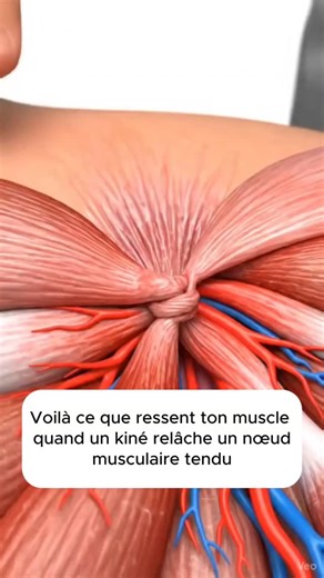 Brigade Antirouille on Instagram: "💆‍♂️ Voici exactement ce que ressent ton muscle quand un kiné libère un nœud. Et tu vas vouloir faire ça plus souvent… 💬 Commente "ROUTINE" pour recevoir une routine articulaire gratuite qui soulage et détend en profondeur. Tu as déjà senti une boule douloureuse dans un muscle ? Ce qu’on appelle un nœud musculaire ou “trigger point” ? Ce n’est pas juste un petit inconfort, c’est un signal d’alerte : le muscle est contracté en permanence, mal irrigué, et inhib