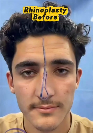 Rhinoplasty Results: Before and After in One Week
