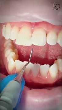 Watch Me At Work! | Composite Edge Bonding 💎