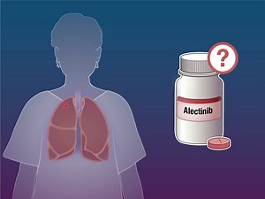 16K views · 43 reactions | Among patients with resected ALK-positive NSCLC, standard adjuvant platinum-based chemotherapy is associated with only modestly improved survival and a high risk of adverse events. Alectinib might improve outcomes. Research findings are summarized in Quick Take video. https://nej.md/3VUzf3M | The New England Journal of Medicine | Facebook