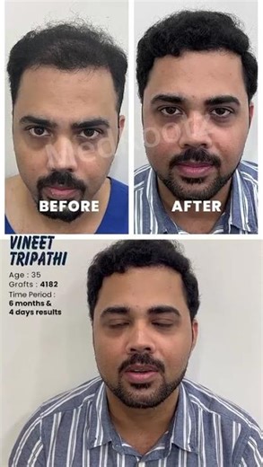 Diffuse Hair Loss Successfully Restored | MedMagic at MedRootz