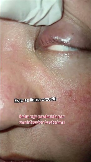 Inflamacion del parpado superior.