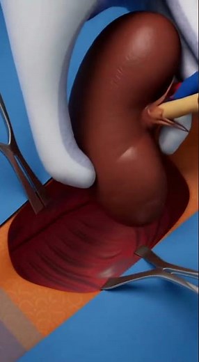 How a Kidney Transplant Is Done | Full Surgical Process Explained