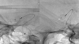 Unruptured Acom Aneurysm treated with a WEB Device