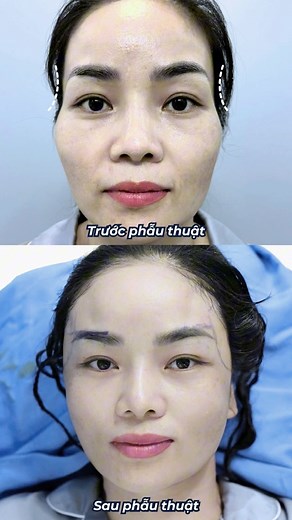 Gương mặt tròn đầy, phúc hậu chỉ sau 60 phút thực hiện ĐỘN THÁI DƯƠNG! #DrRichardHuy #Kangnam | Dr. Richard Huy