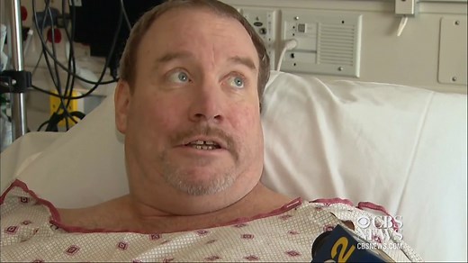 Long road to recovery after toxic spider bite