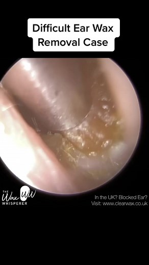 #ear #earwax #earwaxremoval #earwaxcleaning #earwaximpaction #audiologist