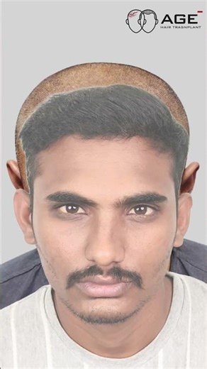 HAIR TRANSPLNAT IN RAJKOT | GRADE 2 Case OF DHI HAIR TRANSPLANT BEFORE AFTER RESULT