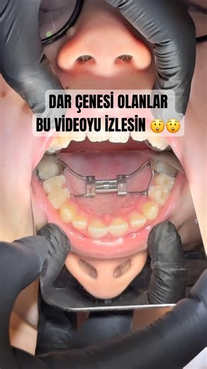 DAR ÇENEYE ÇÖZÜM #smiledesigndental #music #orthodontist #dentalartistry #veneers