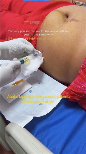 paracentesis step by step |Ascitic tapping procedure | indian respiratory Therapist