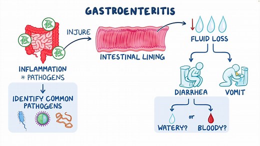 Video: Infectious gastroenteritis: Clinical sciences - Video Explanation! | Osmosis | Osmosis