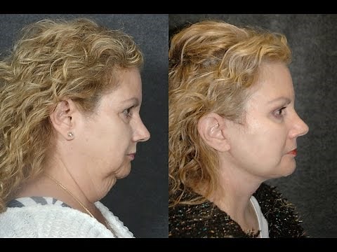 Lower Facelift and Necklift Before and After | Dr Andrew Jacono Reviews