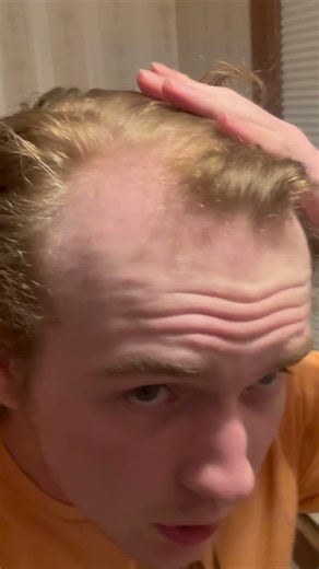 6 Year Hair Loss Transformation #baldcafe