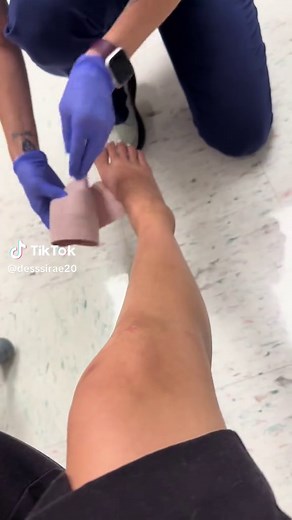 First Ankle Fracture Experience and Recovery Tips