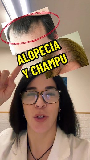 Tratamiento de la alopecia androgenética con champú de ketoconazol