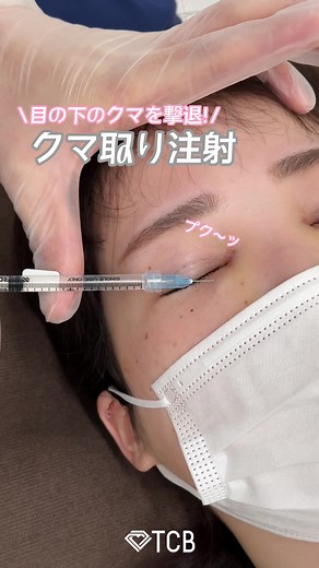 目の下のクマ取り注射の効果と手順