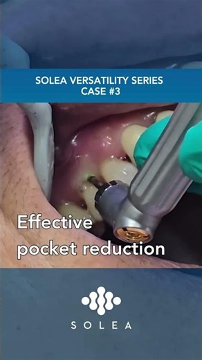 Solea® Versatility Series Case 3: Periodontal Treatment