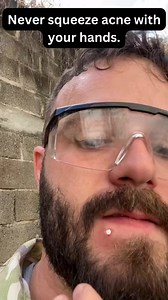 My favorite watch 🤤 | Pimple Popping