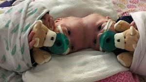 Conjoined twin girls separated by CHOP surgeons