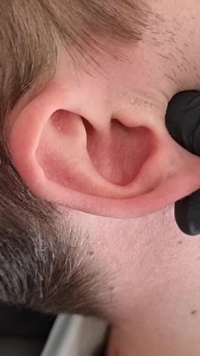Ear Adjustment #chiropractor #chiropracticadjustment #crackingbones #osteopathy #doctorsoftiktok #duet #duetwithme #tagafriend #foryou #fyp #neiperte #viraltiktok #virall | Il Doc Osteopata