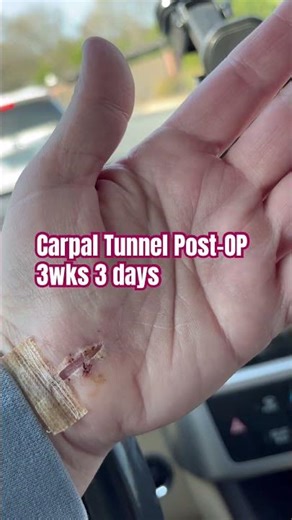 Carpal Tunnel Post Op | 3wks & 3days