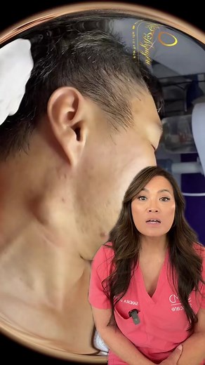 #duet with @huldapimplesatify gotta get that sac out or it might come back! #drpimplepopper #popaholic #cystremoval