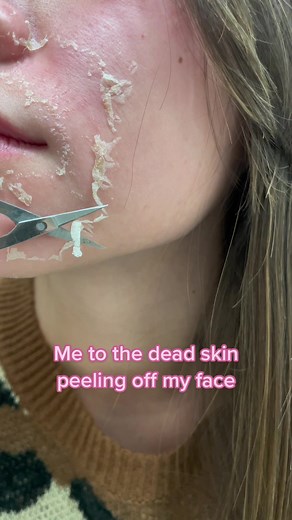 Chemical Peel Process and Facial Peels Journey