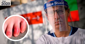 'Rashes, swollen hands and feet': The unusual symptoms of coronavirus